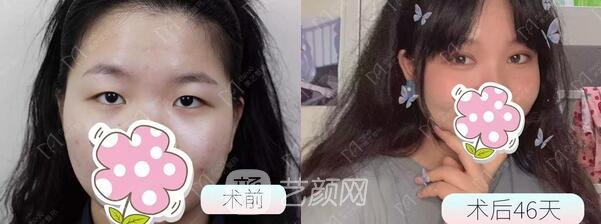 全切雙眼皮+開(kāi)內(nèi)眼角手術(shù)案例