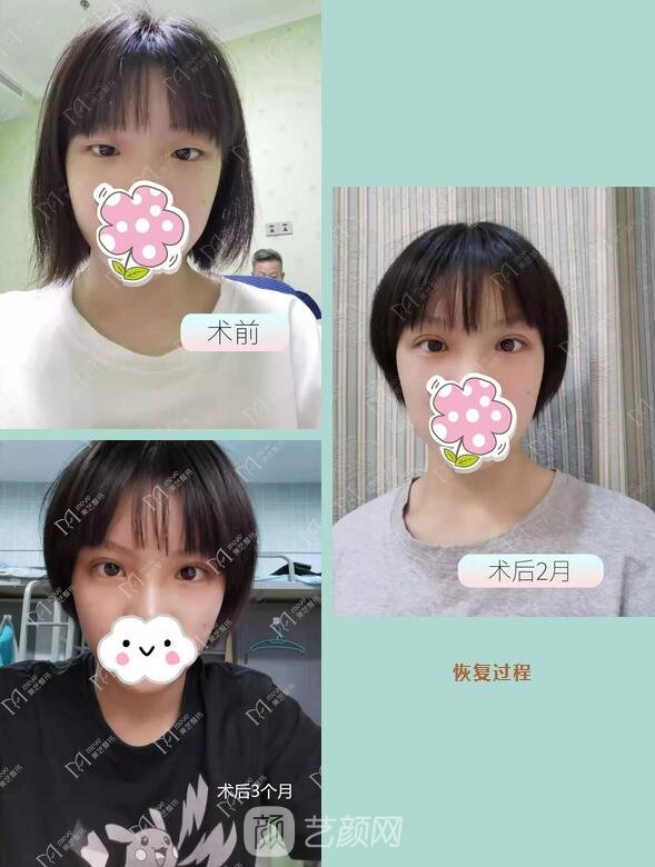 全切雙眼皮+開(kāi)內(nèi)眼角