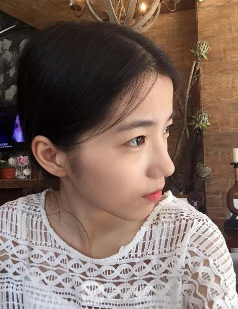 雙眼皮案例術(shù)前照片