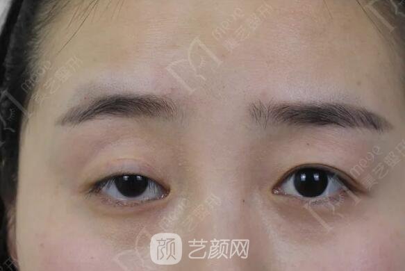 上瞼下垂如果不重視雙眼皮做了也白做！