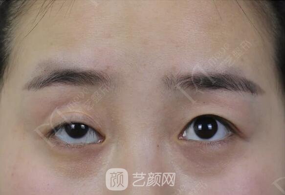 上瞼下垂如果不重視雙眼皮做了也白做！
