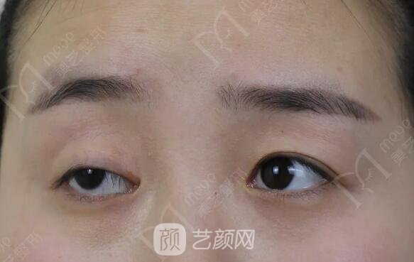 上瞼下垂如果不重視雙眼皮做了也白做！