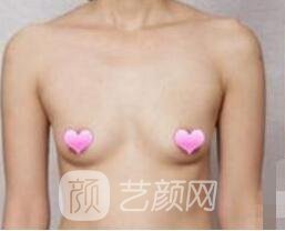 豐胸手術(shù)后可以孕期哺乳嗎?