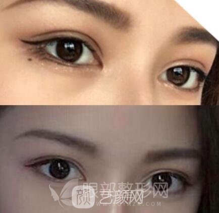 北京做雙眼皮手術(shù)哪里好 多少錢