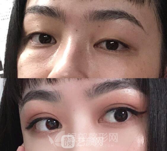 北京做雙眼皮手術(shù)果好不好  案例