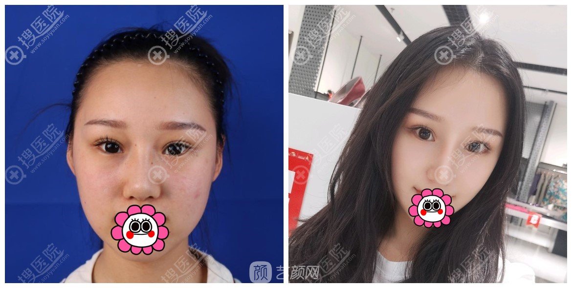 西安畫美楊萬忠肋骨鼻果