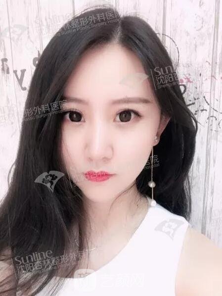 沈陽杏林張宇夫鼻部手術案例