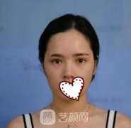 廣州曙光整形美容醫(yī)院隆鼻怎么樣?案例分享