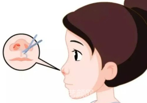 上海九院鼻子價(jià)格是多少