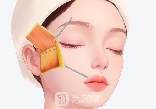 小切口筋膜懸吊術(shù)能維持