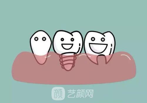 韓國(guó)美格真種植體的優(yōu)缺點(diǎn)曝光!屬于什么檔次?