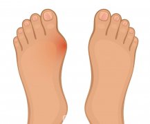 蘇敬達(dá)做大腳骨手術(shù)技術(shù)