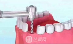 奧齒泰種植牙價(jià)格多少錢(qián)