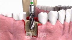 法國安卓健種植牙是什么