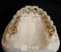 純鈦金屬牙齒好不好？當(dāng)