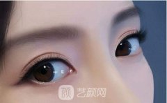 埋線雙眼皮能維持幾年？