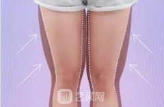 大腿內(nèi)側(cè)吸脂多久恢復？