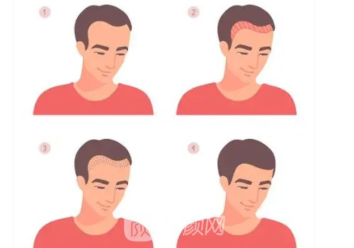 重慶種植頭發(fā)多少一個毛