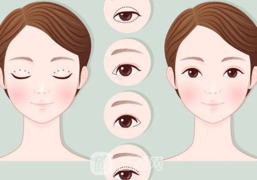 武鳳蓮做雙眼皮案例圖片