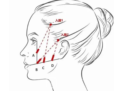 醫(yī)美輪廓固定多少錢?參考