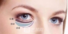 內(nèi)切眼袋恢復(fù)期要多久？