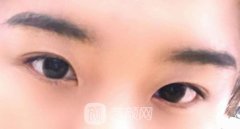 眼睛蒙古褶怎么消除？蒙