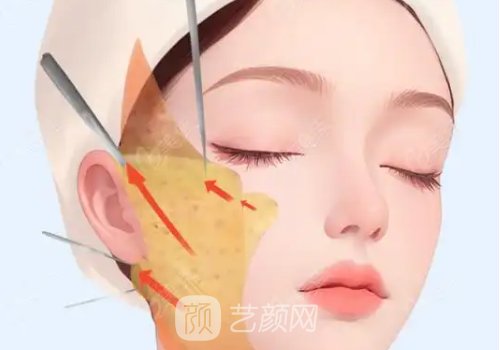 童顏微提3.0效果怎么樣?很