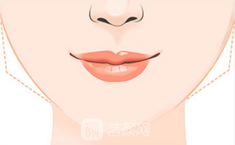 廈門磨骨手術(shù)多少錢?參考